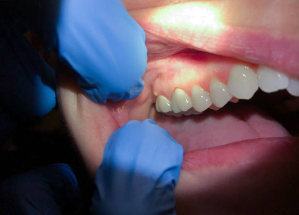 Best Emergency Dental Care for Broken or Chipped Teeth in Doylestown, OH