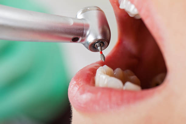 Best Emergency Wisdom Teeth Removal in Doylestown, OH